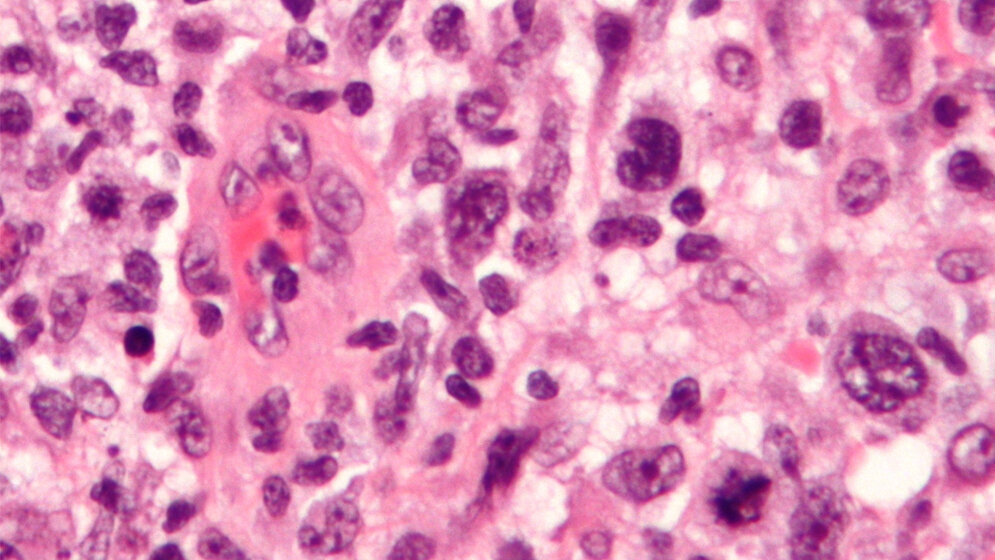 Histologisches Präparat eines ALCL in HE-Färbung