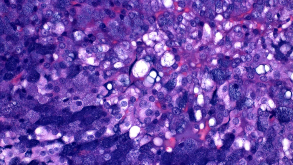 Azinuszellkarzinom der Speicheldrüse