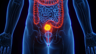 Wirkung von Aspirin auf Darmkrebs