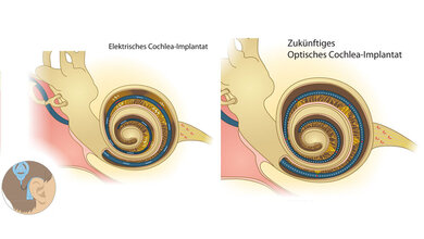 optogenetisches Implantat 