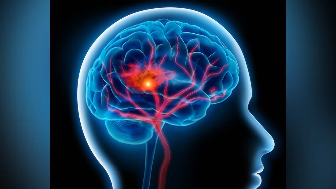 Ischämische Schlaganfälle behandeln