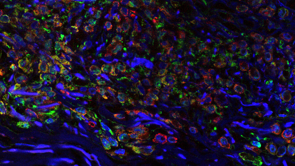 Tumor in situ