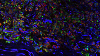 Tumor in situ