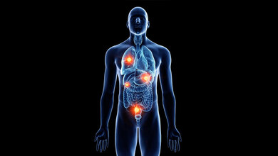 Abbildung eines Körpers mit Metastasen