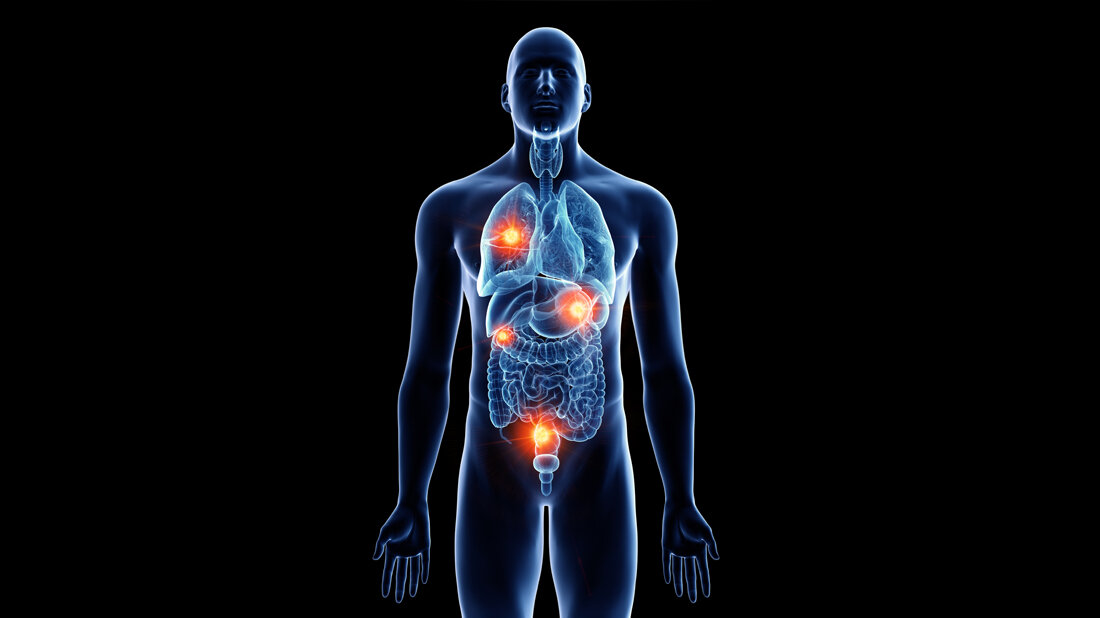 Metastasenbildung.jpg Abbildung eines Körpers mit Metastasen