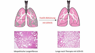 Neuer Behandlungsansatz gegen Lungenfibrose