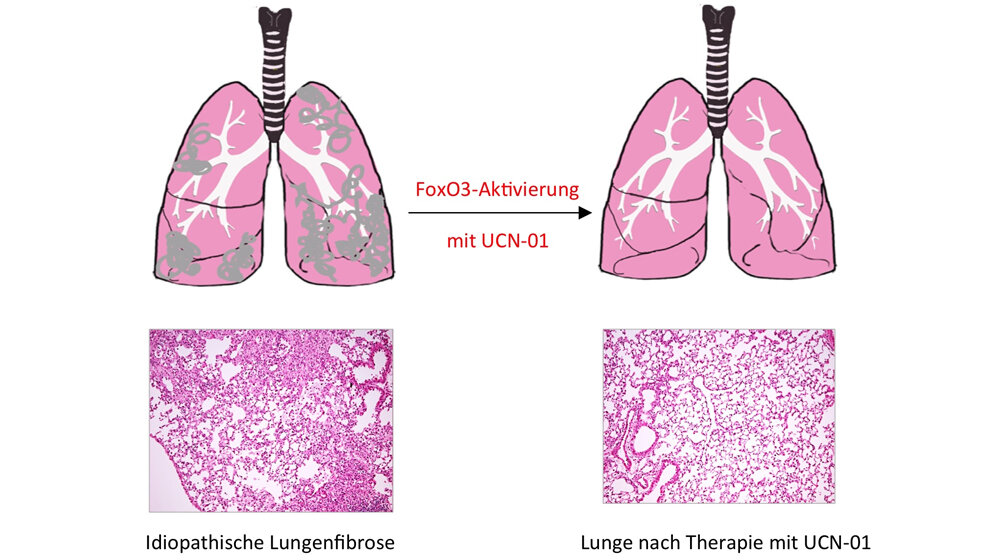 Neuer Behandlungsansatz gegen Lungenfibrose