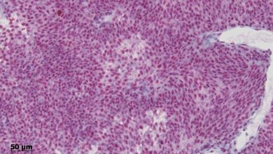 Sehr starke Färbung der Tumorzellen