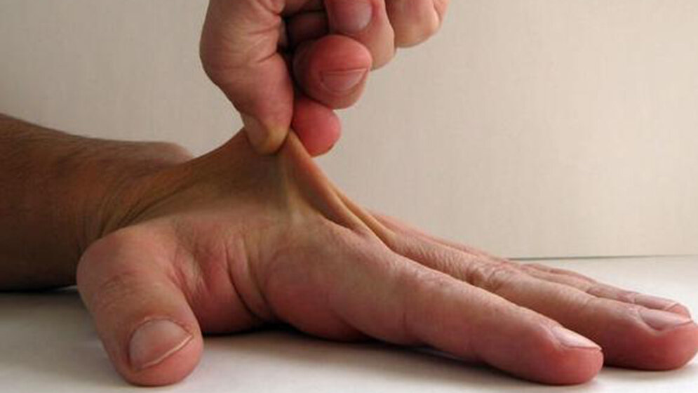 Ehlers-Danlos Syndrom