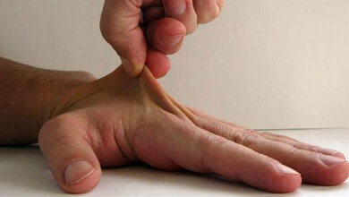 Ehlers-Danlos Syndrom