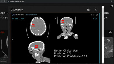 Analyseprogramm prüft anhand von CT-Bildern, ob ein Gefäßverschluss vorliegt