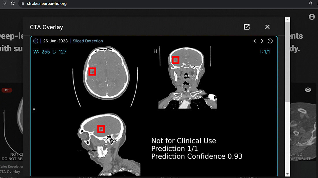 Schlaganfall_KI-Diagnostik.jpg Analyseprogramm prüft anhand von CT-Bildern, ob ein Gefäßverschluss vorliegt