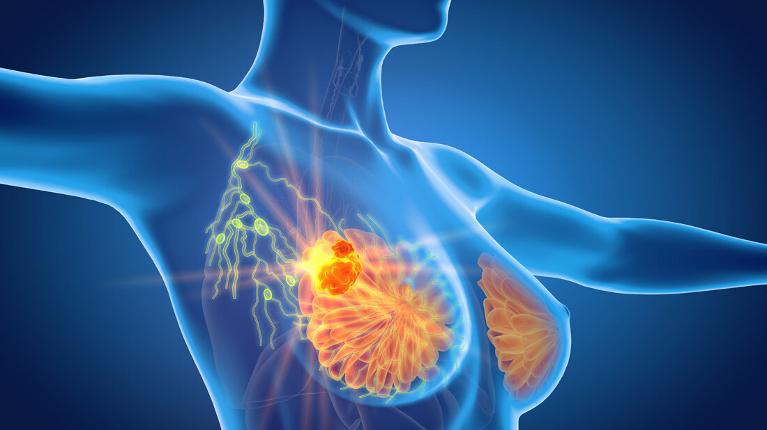 Brustkrebs - Fermetastasen früher entdecken