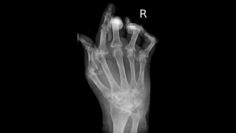Roentgenbild_der_Hand_bei_rheumatoider_Arthritis_By_Bernd_Braegelmann_Braegel.jpg rheumatoide Arthritis