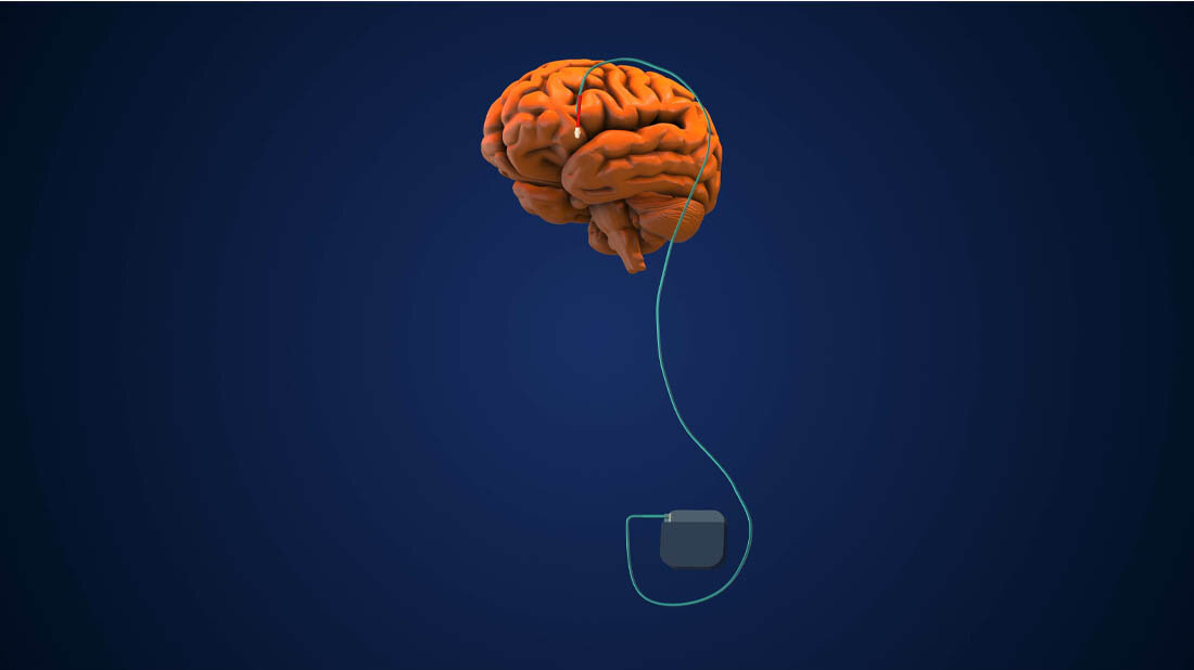 tiefe_Hirnstimulation_bei_Parkinson.jpg Symbolbild einer tiefen Hirnstimulation