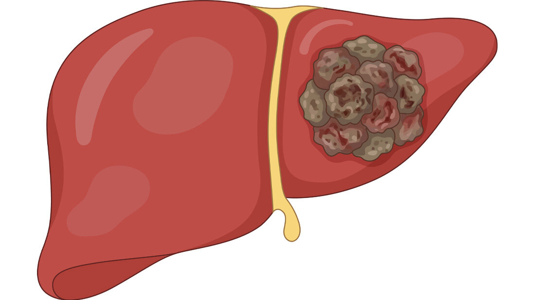 Leberkrebs_02.jpg Symbolbild für Leberkrebs.
