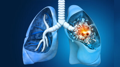 Ein Symbolbild für eine Lunge mit Krankeiten.