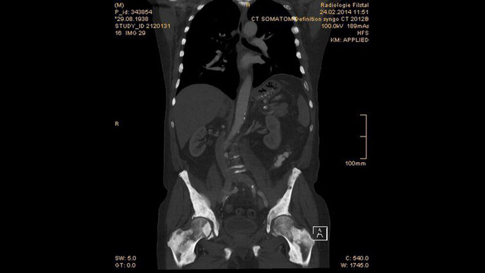 Tumoröse Veränderungen: Osteoplastische Metastasen Schnittbilddiagnostik der Wirbelsäule (4.19)