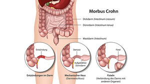 llustration zu Morbus Crohn mit Darstellung von Entzündungen, Stenosen, Fisteln und Darmverschluss im Magen-Darm-Trakt