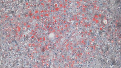 Fettfärbung in der Leber