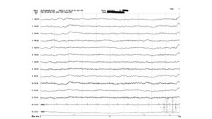Herdbefund im EEG