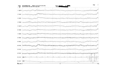 Neurologie Herdbefund im EEG