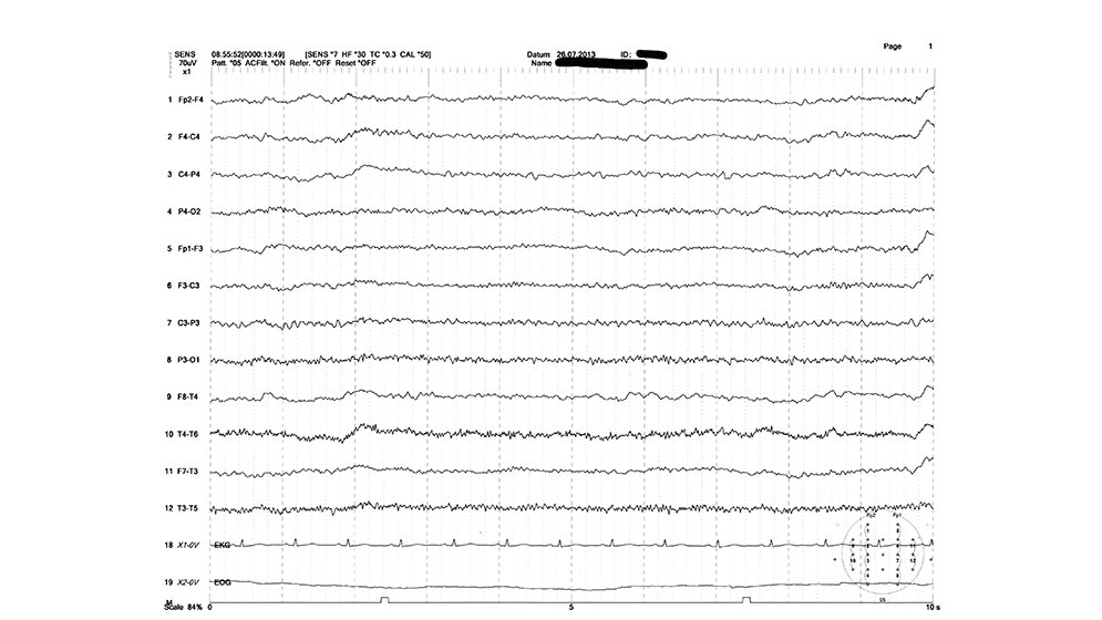Herdbefund im EEG