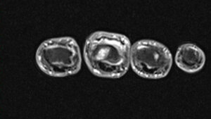 Entzündliche Veränderungen: Rheumatoidarthritis