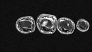 Entzündliche Veränderungen: Rheumatoidarthritis