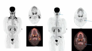 Maßnahmenspektrum zur Verhinderung von aktiviertem braunen Fett in der  18F-FDG-PET