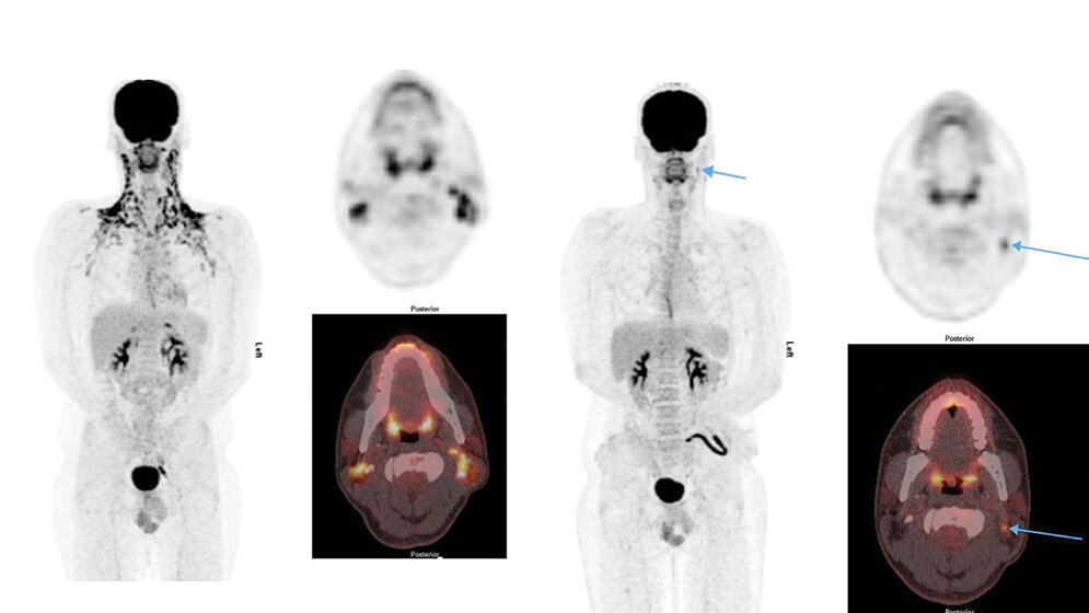 Bildgebende Verfahren Maßnahmenspektrum zur Verhinderung von aktiviertem braunen Fett in der
18F-FDG-PET