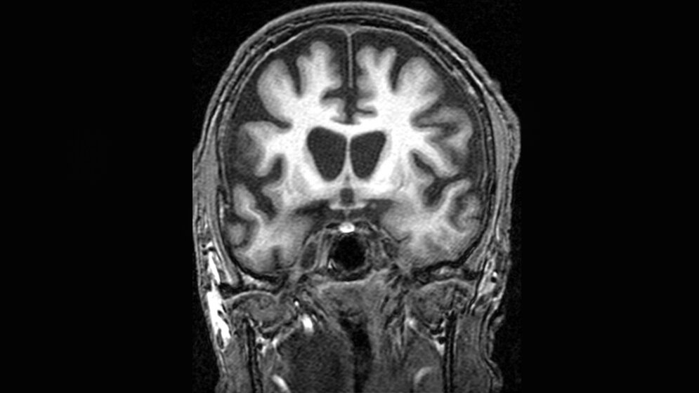 MR-Hirnscan eines Patienten mit Huntington