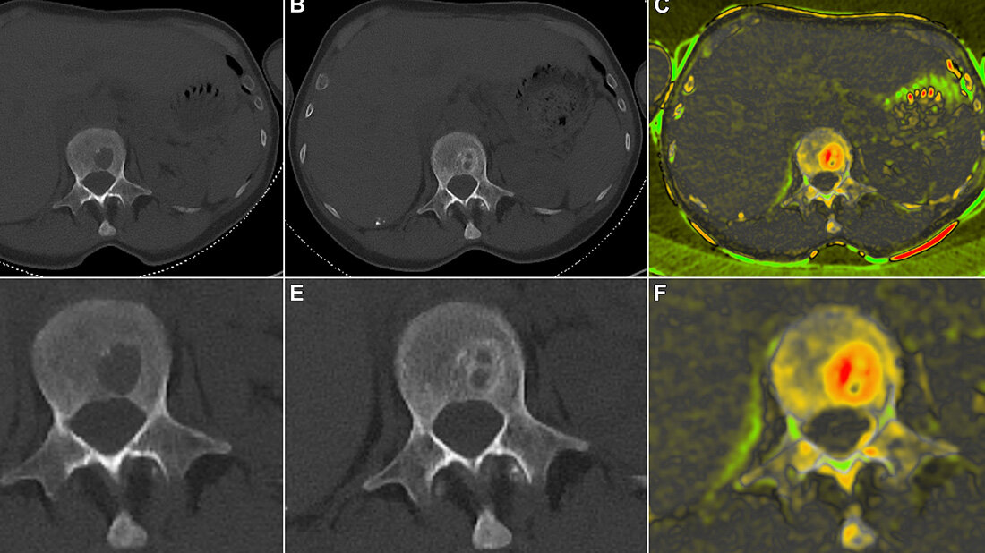 Möglichkeiten der Knochenregeneration bei Patienten mit mutiplem Myelom