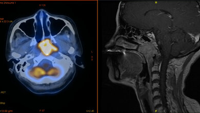 Krebsmedikamente wirken bei COVID-Geimpften besser 