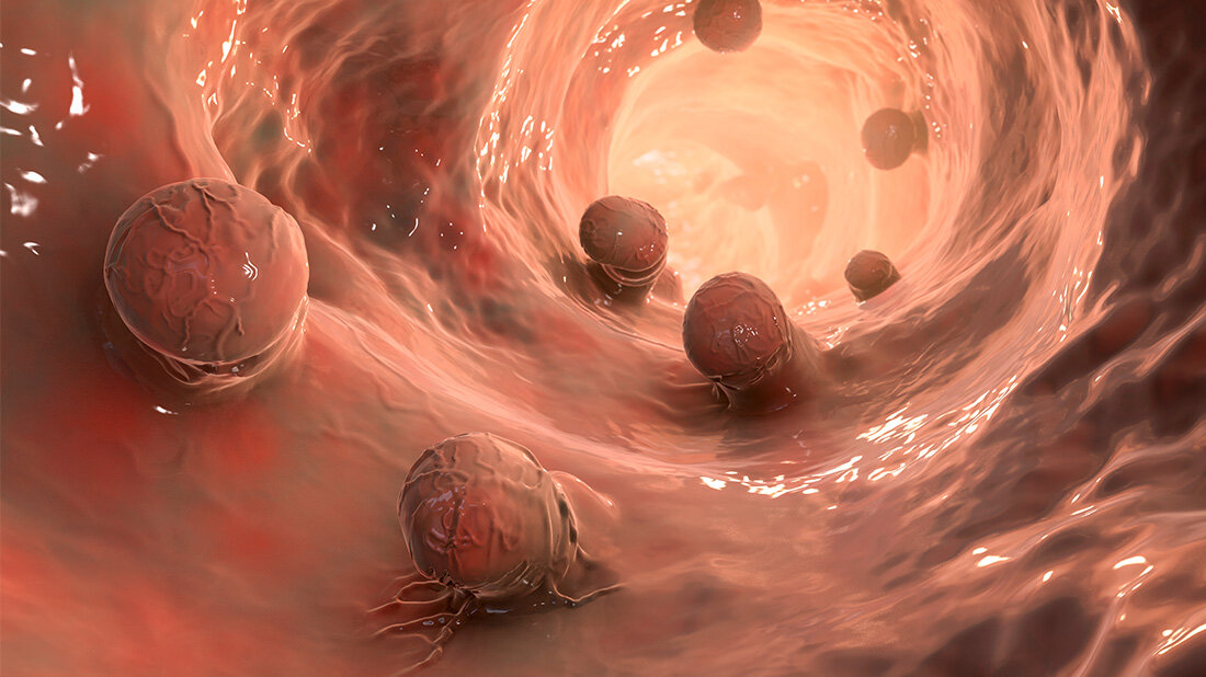 Dickdarmkrebs_Fallzahlen.jpg Dickdarmkrebs-OP: Bessere Prognose bei höheren Fallzahlen