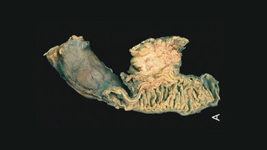 Operativ entfernter Tumor