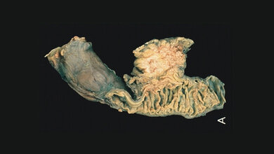 Operativ_entfernter_Tumor_Pankreas_mit_anhaengendem_Zwoelffingerdarm_The_Armed_Forces_Institute_of_Pathology_AFIP_Gemeinfrei.jpg Operativ entfernter Tumor