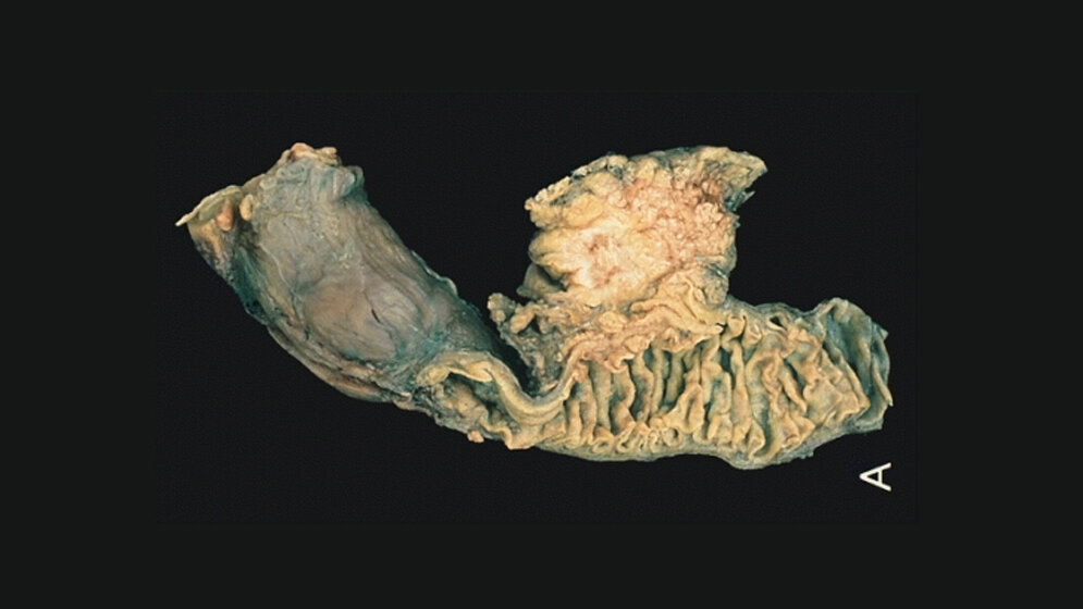 Operativ entfernter Tumor