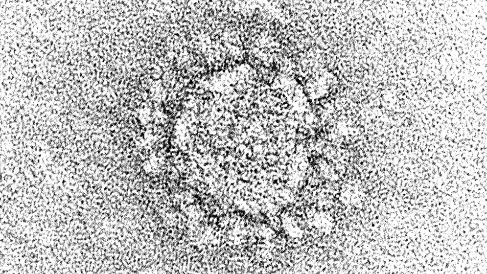 Sonstiges COVID-19-Infektionen bei HIV-infizierten Patienten