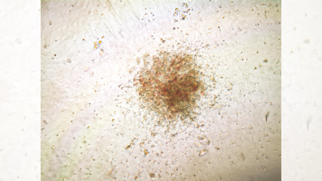 Zellkolonie aus mit der Genschere reparierten menschlichen blutbildenden Stammzellen.