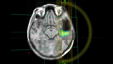 Hirntumore besser bestrahlen