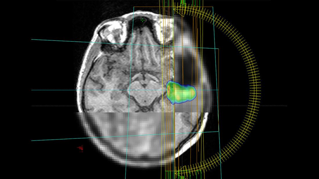 Hirntumore besser bestrahlen