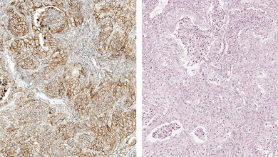 Optimierung und Validierung von PD-L1-Färbeprotokollen am Beispiel E1L3N (Teil 2)