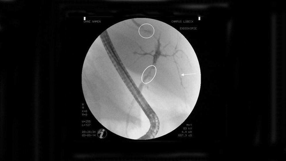 ERCP eines Patienten mit PSC