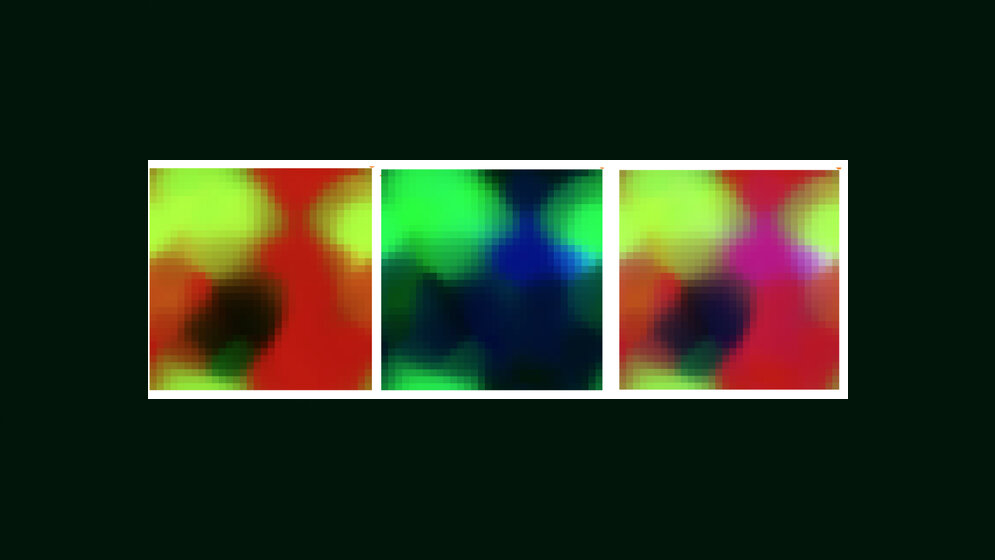 Haarzell_Leukaemie_wie_sie_die_KI_sieht_Max_Zhao.jpg Haarzell-Leukämie