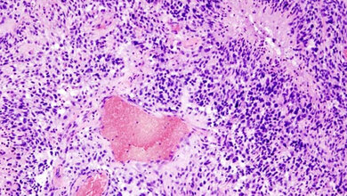 Glioblastom_histologisches_Praeparat_HE_Faerbung_Autor_KGH_CC_BY_SA_3_0.jpg Hirntumoren