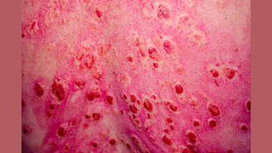 Systemische Lupus erythematodes