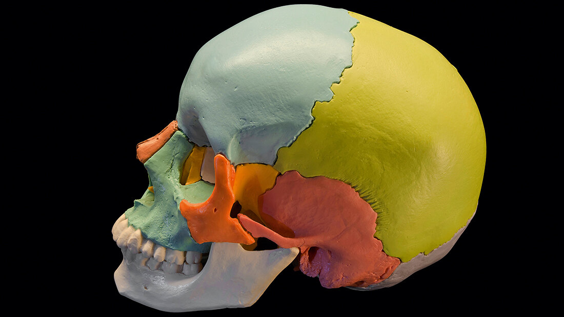 Anomalien und Normvarianten – Skelettale Veränderungen 3.40: Hyperostosis frontalis interna Foto eines menschlichen Schädels mit Schädelknochen in unterschiedlichen Farben