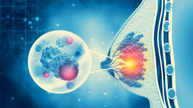 Darstellung von Brustkrebs