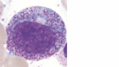 Primärgranulation in myeloischen Zellen Hämatologie-Spezial